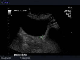 Ultrazvok mehurja - ostje levega sečevoda v mehurju